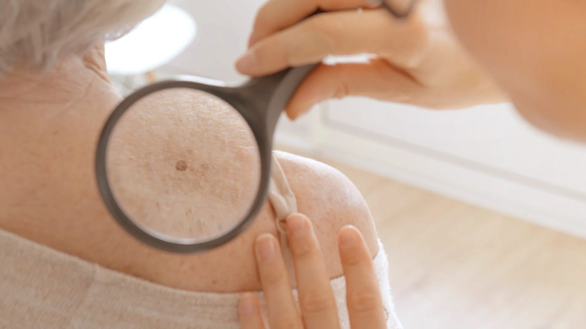 Melanom oder Muttermal: Eine wichtige Unterscheidung